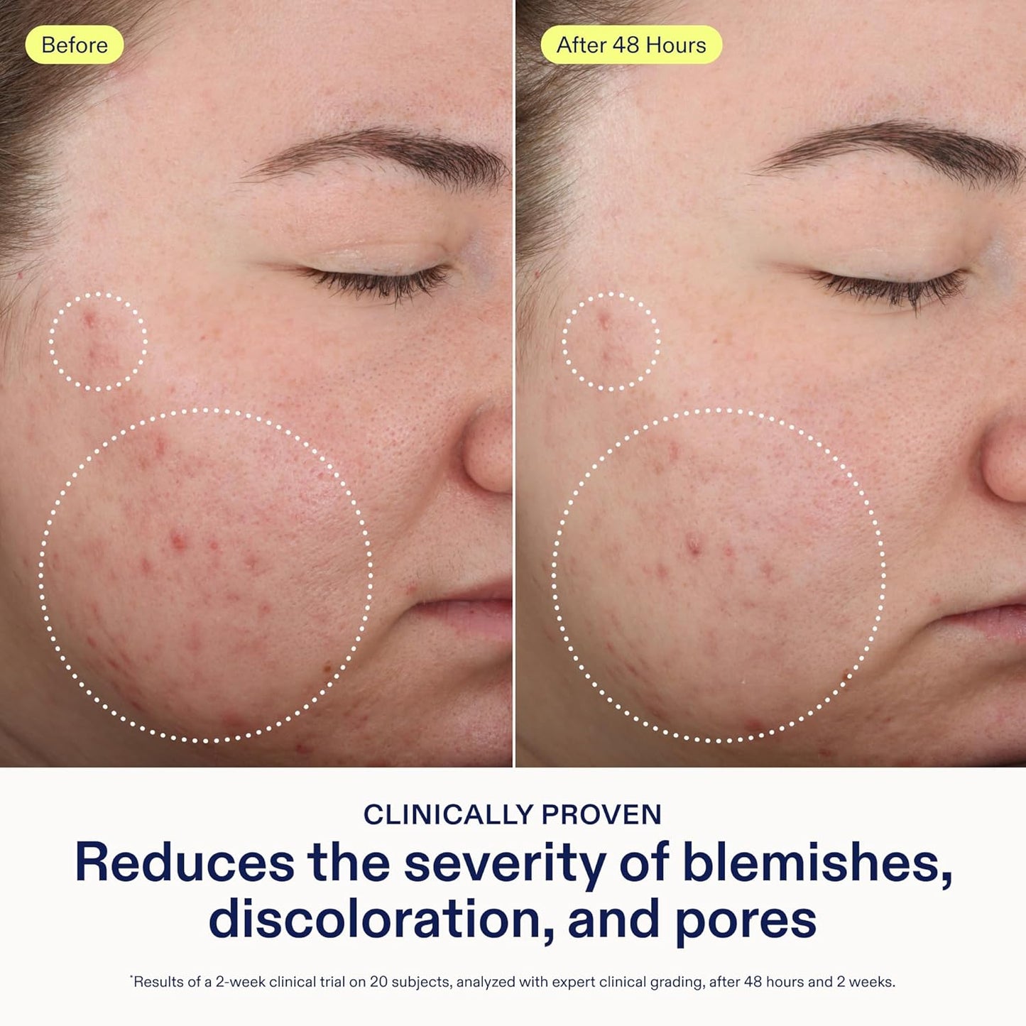 Skinfix 2% BHA Cleanser - 5 oz - Clears Acne Blemishes & Blackheads - Safe for All Types of Acne - Fragrance Free - Vegan, Cruelty Free