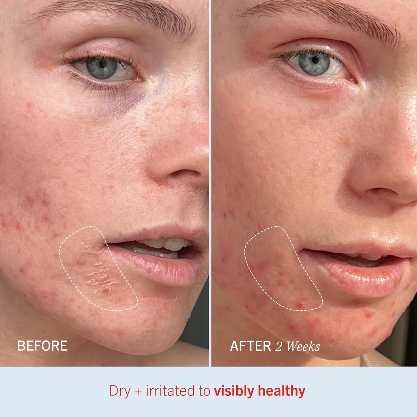 First Aid Beauty - Ultra Repair Cream, Intense Hydration Whipped Colloidal Oatmeal, Clinically Proven to Strengthen Skin Barrier in 7 Days & Helps Relieve Eczema, Luxury Face & Body Moisturizer, 8 oz